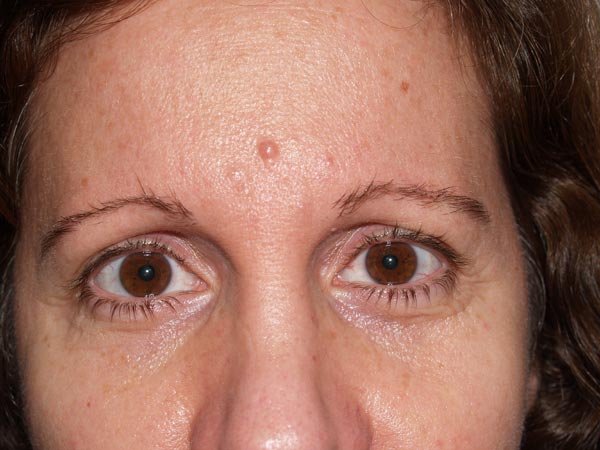 eyebrow transplant - patient 30 - before 1