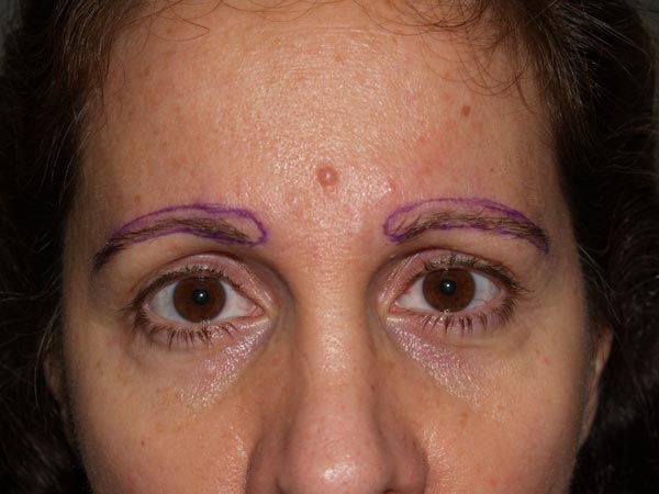 eyebrow transplant - patient 30 - before marked 1