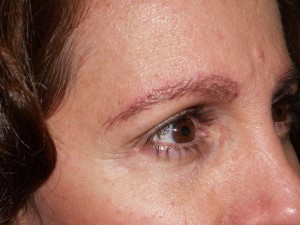 Miami, Fl. Eyebrow transplant Photo - Patient 1 - After 2