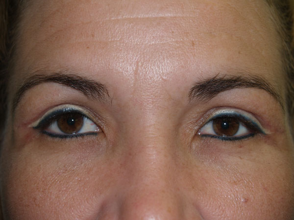 eyebrow transplant - patient 35 - after 1