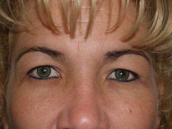 eyebrow transplant - patient 35 - before 1