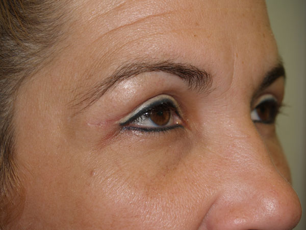eyebrow transplant - patient 35 - before 2