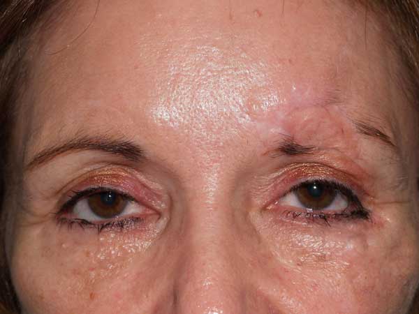 eyebrow transplant - patient 37 - before 1