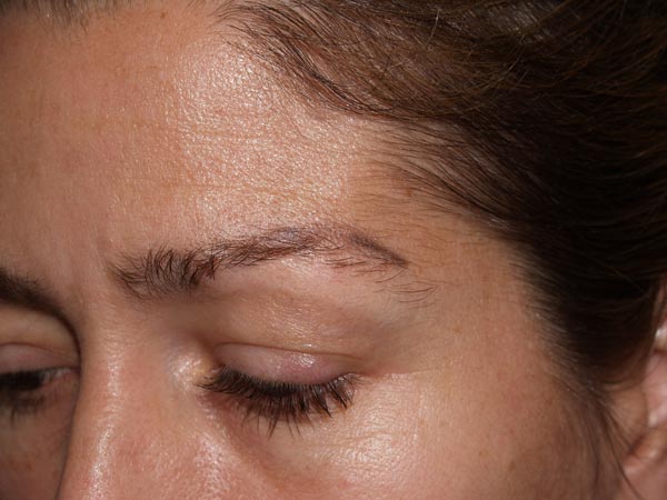 eyebrow transplant - patient 38 - before 2