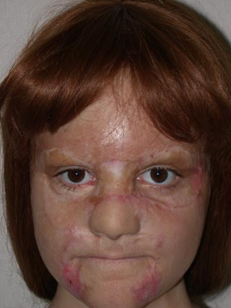 eyebrow transplant - patient 41 - before 1