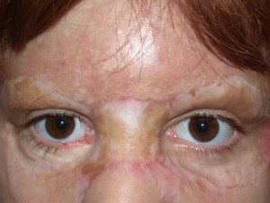 Miami, Fl. Eyebrow Transplant Photo - Patient 1 - Before 2