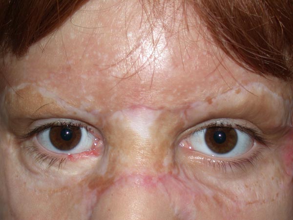 eyebrow transplant - patient 41 - before 2