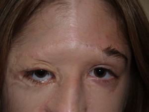 Miami, Fl. Eyebrow Transplant Photo - Patient 1 - Before 1