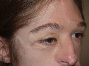 Miami, Fl. Eyebrow Transplant Photo - Patient 1 - After 2