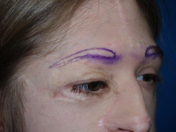 eyebrow transplant - patient 42 - before 2