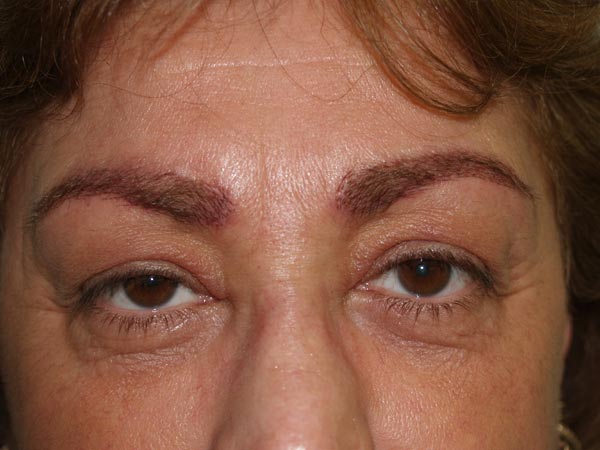 eyebrow transplant - patient 45 - after 1