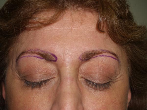 eyebrow transplant - patient 45 - before 1