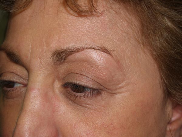 eyebrow transplant - patient 45 - before 2
