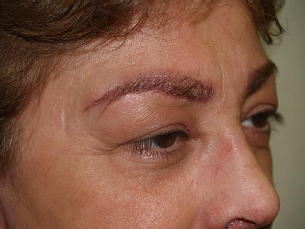 eyebrow transplant - patient 45 - after 3