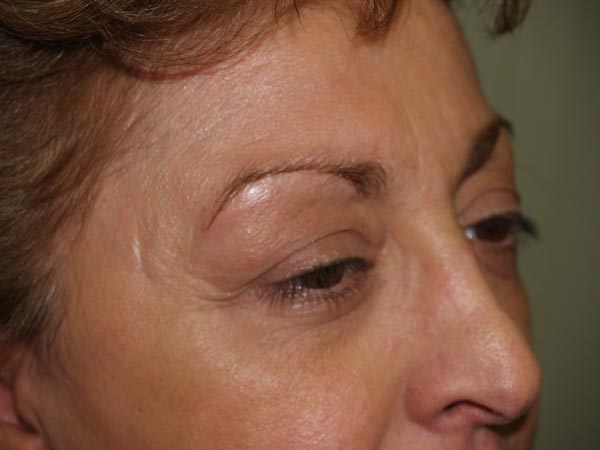 eyebrow transplant - patient 45 - before 3