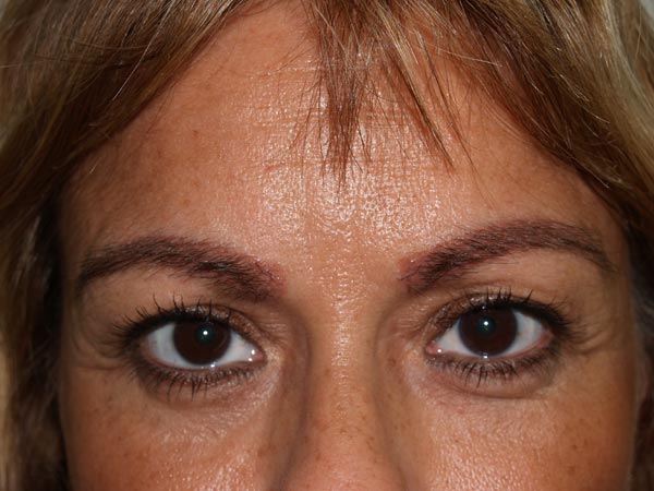 eyebrow transplant - patient 52 - after 1