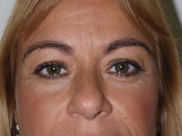 eyebrow transplant - patient 52 - after 3