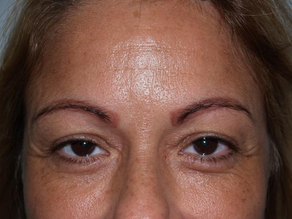 eyebrow transplant - patient 52 - before 1