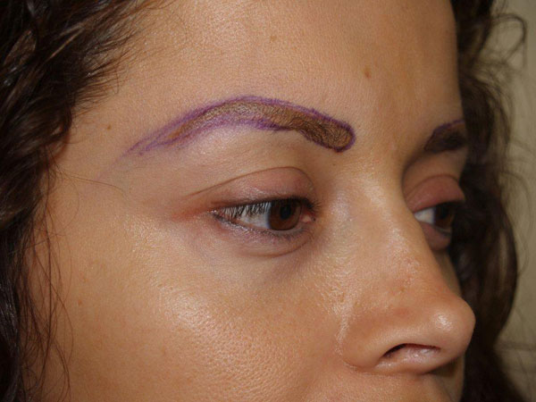 eyebrow and eyelashes - patient 64 - before 1