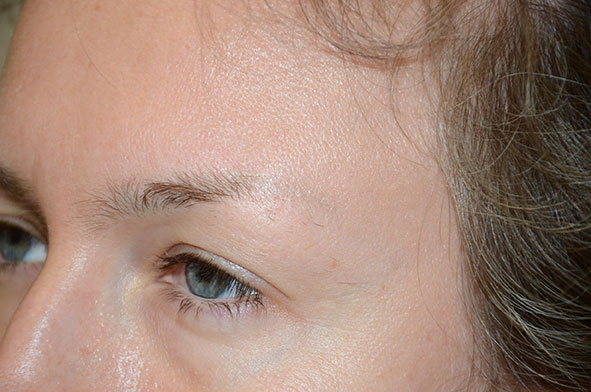 eyebrow transplant - patient 1 - before 3