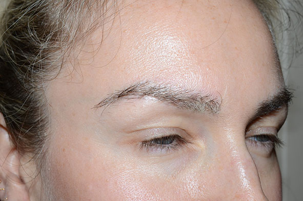 eyebrow transplant - patient 1 - after 2