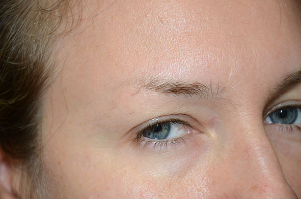eyebrow transplant - patient 1 - before 2