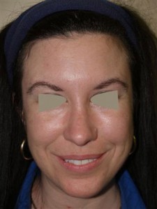 Miami, Fl. Eyebrow Transplant Photo - Patient 1 - After 1