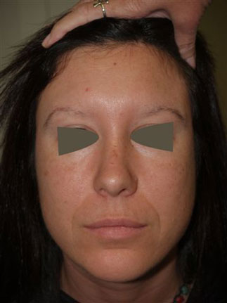 eyebrow transplant - patient 54 - before 1