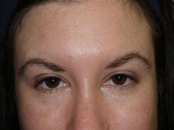eyebrow transplant - patient 54 - after 2
