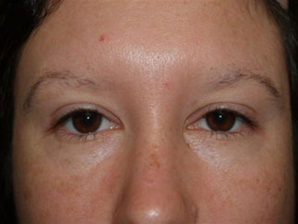eyebrow transplant - patient 54 - before 2