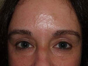 Miami, Fl. Eyebrow Transplant Photo - Patient 1 - After 1