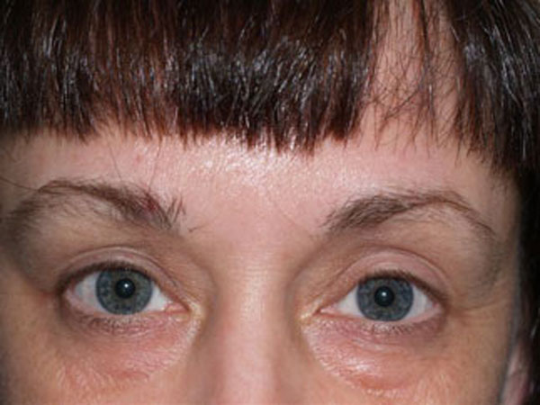 eyebrow transplant - patient 55 - before 1