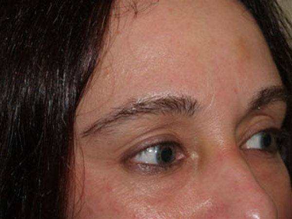 eyebrow transplant - patient 55 - after 2