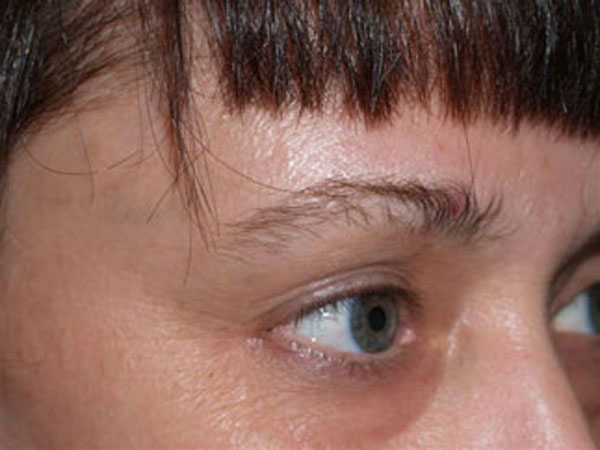 eyebrow transplant - patient 55 - before 2
