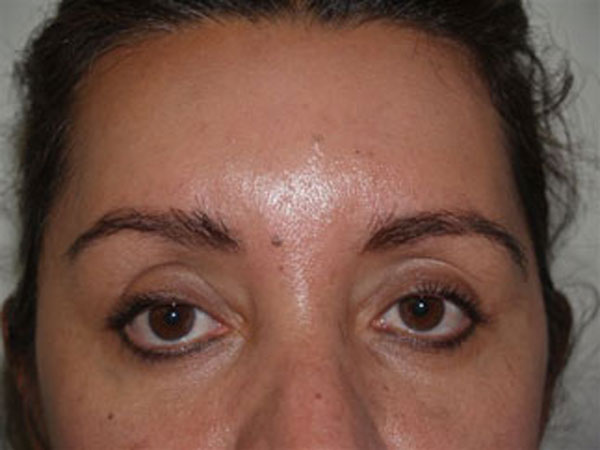 eyebrow transplant - patient 56 - after 2