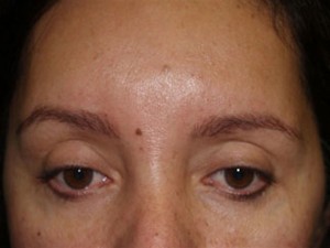 Miami, Fl. Eyebrow Transplant Photo - Patient 1 - Before 2