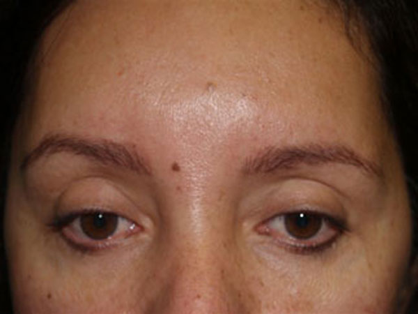 eyebrow transplant - patient 56 - before 2