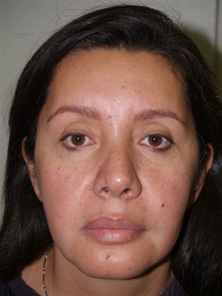 eyebrow transplant - patient 56 - before 1