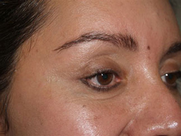 eyebrow transplant - patient 56 - after 3