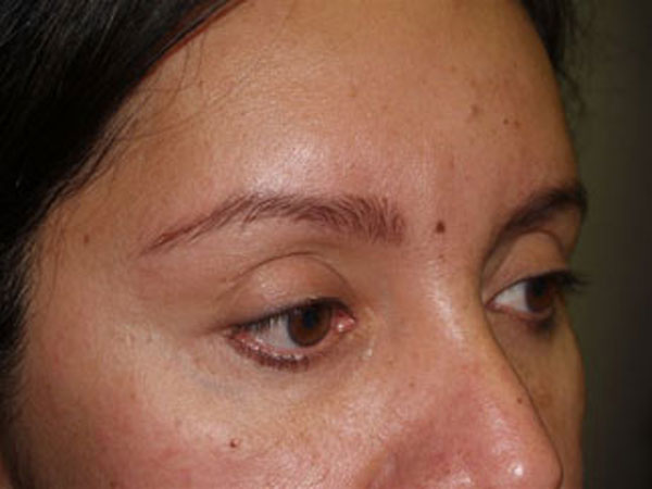 eyebrow transplant - patient 56 - before 3