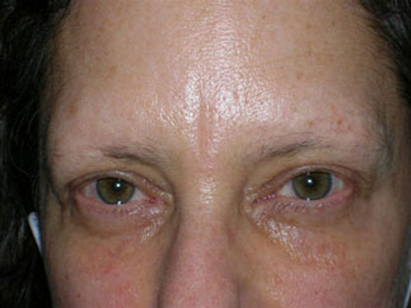eyebrow transplant - patient 58 - before 1