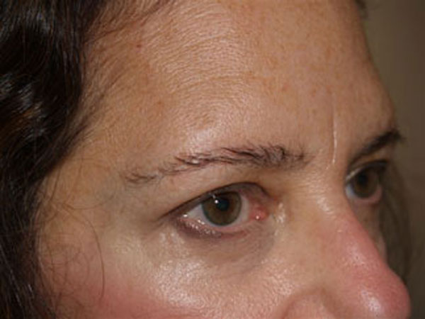 eyebrow transplant - patient 58 - after 2