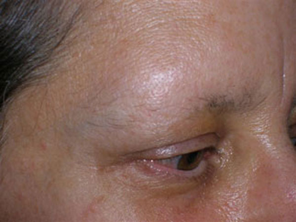 eyebrow transplant - patient 58 - before 2