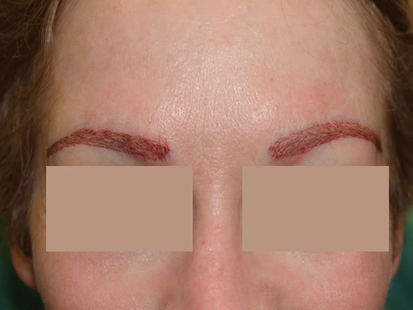 eyebrow and eyelashes - patient 76 - after 1