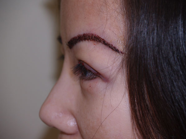 eyebrow and eyelashes - patient 78 - after immediately 1