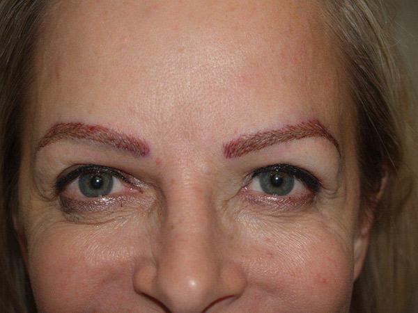 eyebrow and eyelashes - patient 82 - after immediately 1