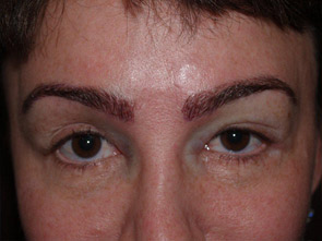 eyebrow and eyelashes - patient 109 - after immediately 1