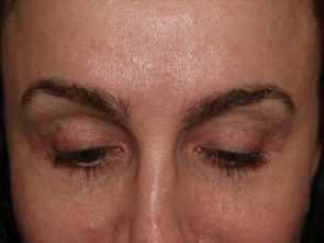 eyebrow and eyelashes - patient 109 - after 1