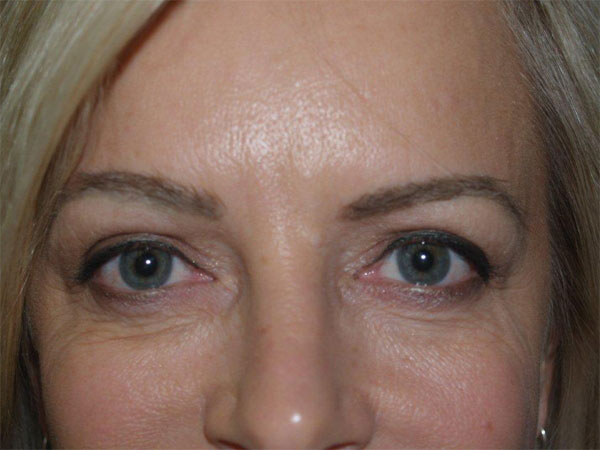 eyebrow and eyelashes - patient 82 - after 1