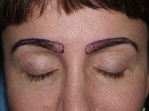 eyebrow and eyelashes - patient 109 - before 1
